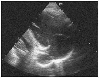 Рис. 3. Зображення вхідного шляху правого шлуночка з парастернального підходу