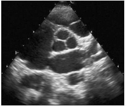Рис. 6. Парастернальне зображення по короткій осі на рівні аортального клапана. 