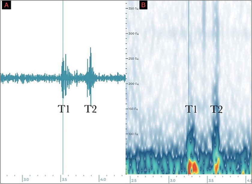 Рис. 2. Нормальні тони, порівняння двох способів візуалізації звуку: А – ​осциляційна фонокардіограма, В – ​спектрограма