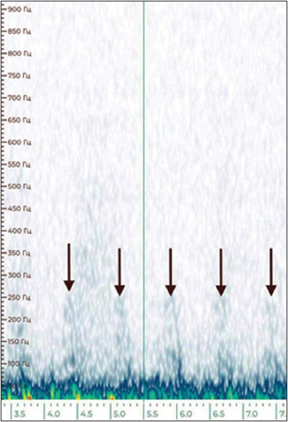 Рис. 3. Судинний шум (позначено стрілками) на спектрограмі звуку, записаного над лівою загальною сонною артерією