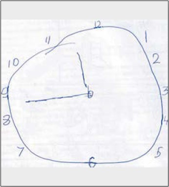 Рисунок 6. Тест малювання годинника пацієнта С.