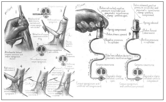 Рис. 36. Встановлення пневматичного пристрою (штучний сфінктер) для утримання сечі у чоловіків за Foley (1947) [36]