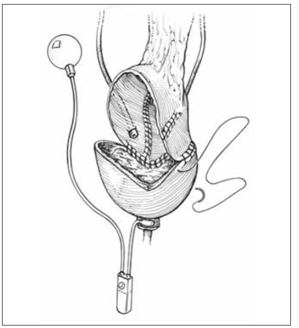 Рис. 38. Аугментаційна цистопластика та встановлення штучного сфінктера уретри АМS 800 при нейрогенній гіперактивності детрузора та сфінктерній недостатності уретри [34]