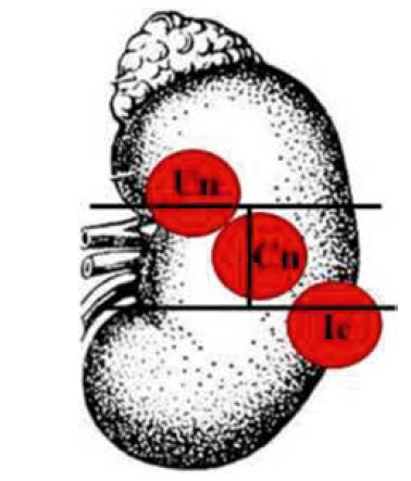 Рис. 3. Позначення сегментів розташування пухлини в нирці (варіант 2):
