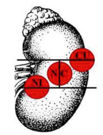 Рис. 4. Позначення сегментів розташування пухлини в нирці (варіант 3):