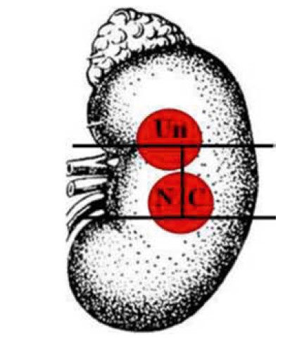 Рис. 5. Позначення сегментів розташування пухлини в нирці (варіант 4):