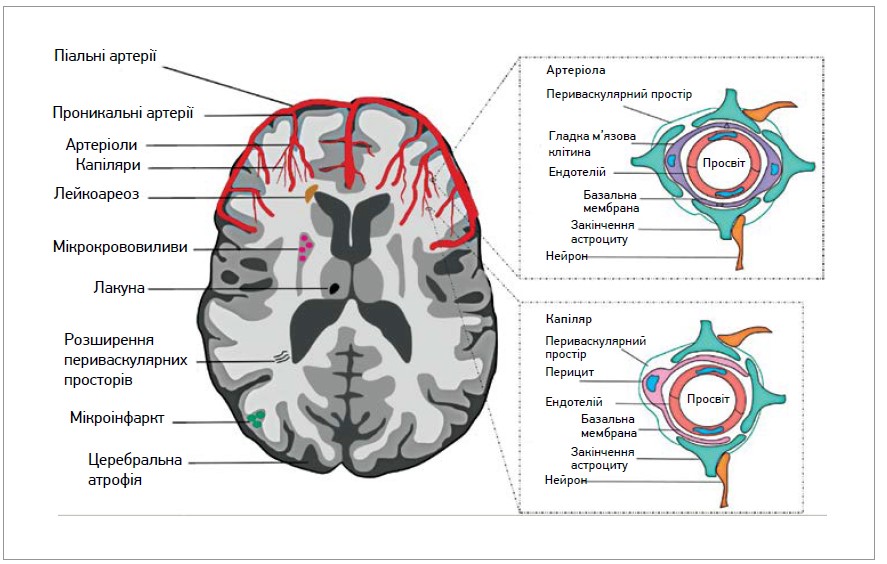 Рис. 1. Мережі дрібних судин головного мозку, в т. ч. піальні та проникальні артерії, артеріоли, капіляри. Маркерами нейровізуалізації ЦХДС на МРТ є лейкоареоз, церебральні мікрокрововиливи, лакуни, розширені периваскулярні простори, мікроінфаркти, церебральна атрофія (модифіковано згідно з Yang Q. et al., 2022) [51]