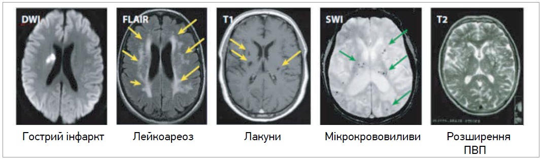 Рис. 3. Ключові ураження ЦХДС, які зазвичай спостерігаються на МРТ головного мозку