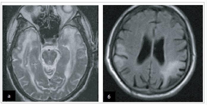 Рис. 8. а) МРТ у режимі T2 показує поширену лейкоенцефалопатію з вираженим ураженням передніх скроневих часток за CADASIL-синдрому (згідно з Locatelli M. et al., 2020) [24]; б) МРТ‑послідовність FLAIR показує типові інсультоподібні ураження (кортикальні та підкіркові гіперінтенсивності), що охоплюють двобічні тім’яні ділянки при MELAS-синдромі (згідно з Yi Shiau Ng et al., 2019) [33]