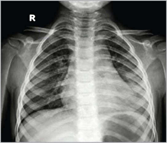 Рис. 1. Рентгенограма ОГК хлопчика 4 років із риновірусом і пневмококовим щепленням, без антибіотикотерапії