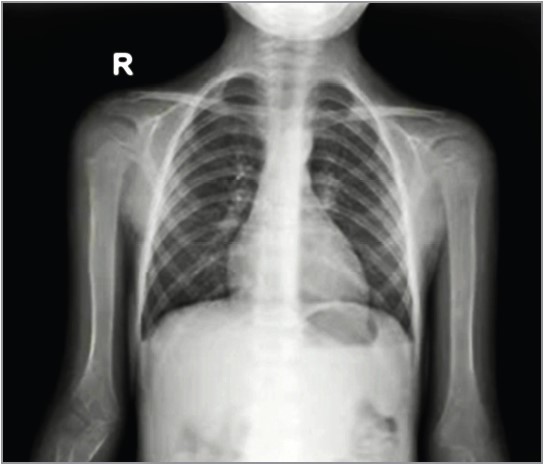 Рис. 2. Рентгенограма ОГК хлопчика 6 років з аденовірусом, без пневмококового щеплення, з антибіотикотерапією