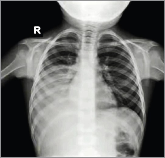 Рис. 3.  Рентгенограма ОГК хлопчика 9 років із правобічною лобарною пневмонією, правобічним плевритом, без щеплення