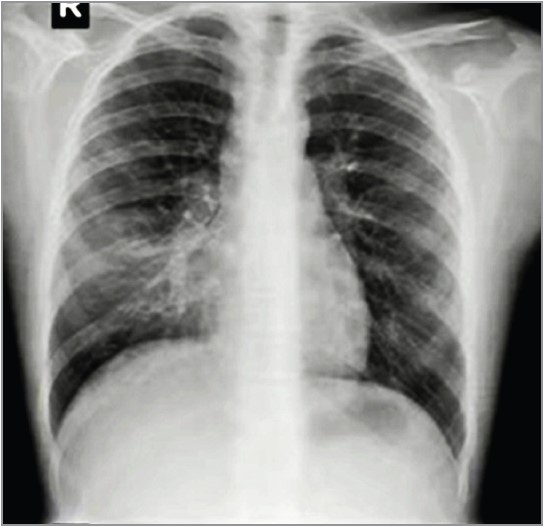 Рис. 4.  Рентгенограма ОГК дівчинки 14 років із Mycoplasma pneumoniae