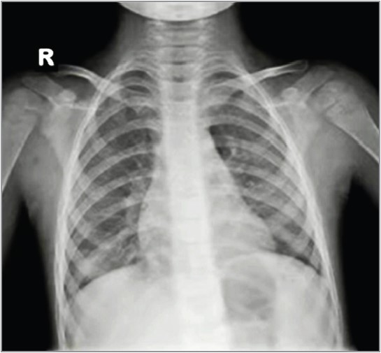 Рис. 6.  Рентгенограма ОГК хлопчика 6 років із РС-вірусом і щепленням Превенаром, без антибіотикотерапії