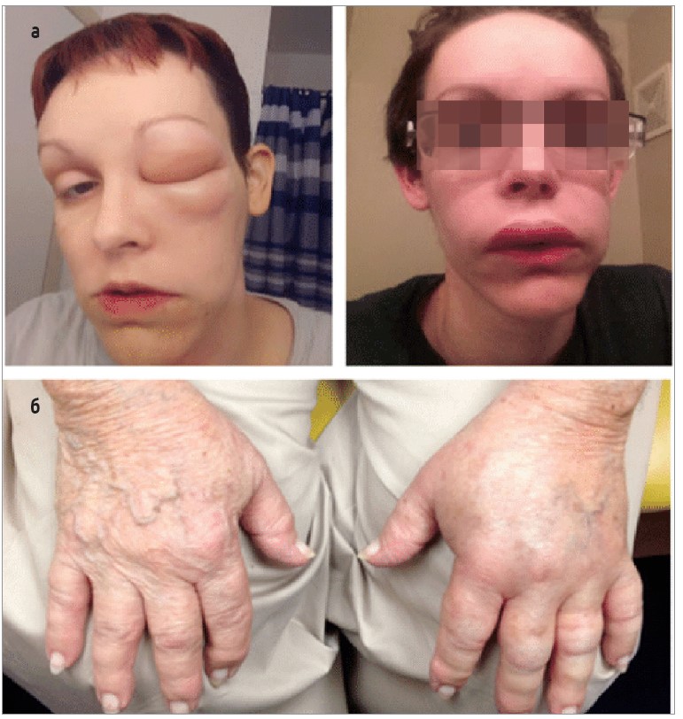 Рис. 2. а) обличчя пацієнтки із САН під час нападу; б) руки пацієнтки із САН під час нападу
