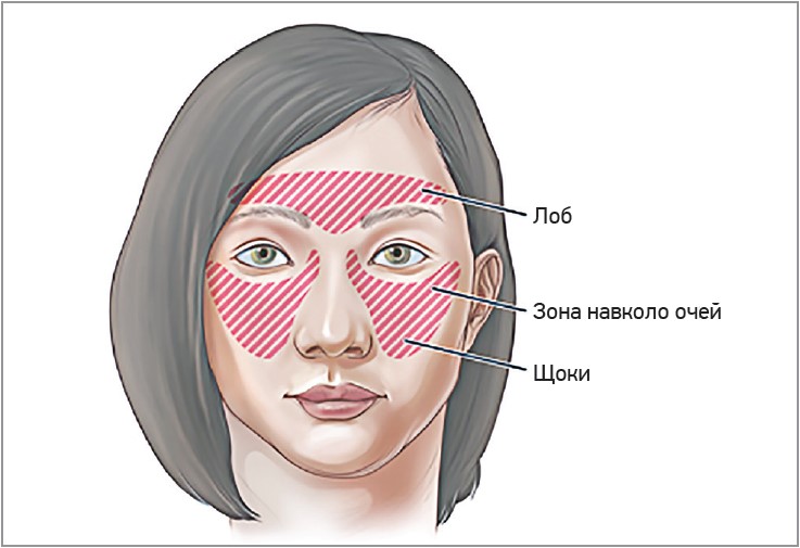Рис. Типові локалізації головного та лицевого болю при РС
