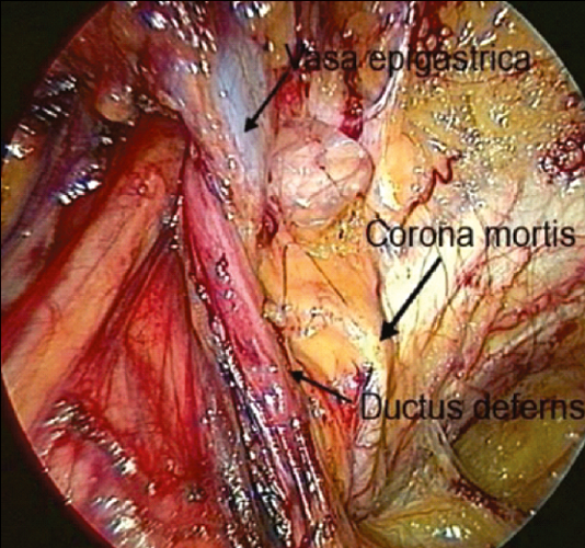 Рис. 16. Вигляд «кільця смерті» з лівого боку при лапароскопічній дисекції [19]