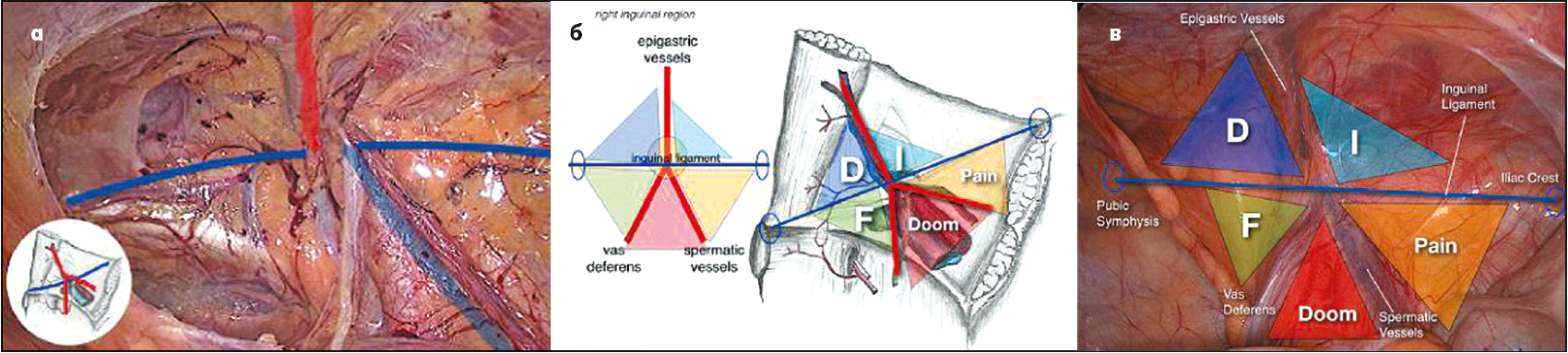Рис. 21. Анатомічна концепція «перевернутої букви Y та п’яти трикутників» із правого боку (а-в) при виконанні лапароскопічної трансабдомінальної пахвинної герніопластики (техніка TAPP). Синьою лінією позначена пахвинна зв’язка, червоною – ​нижні надчеревні судини, сім’явиносна протока та яєчкові судини [16]