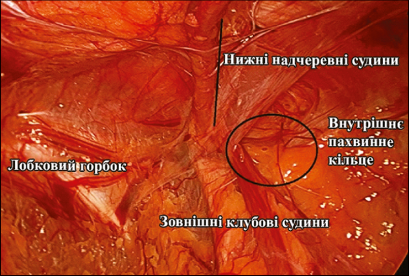 Рис. 23. Інтраопераційний вигляд ретроінгвінального простору Bogros з правого боку із внутрішнім пахвинним кільцем, нижніми надчеревними та зовнішніми клубовими судинами [5, 6]