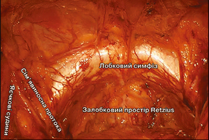Рис. 24. Дисекція в залобковому (Retzius) та ретроінгвінальному просторах при відкритих, лапароскопічних і робот-асистованих операціях на передміхуровій залозі та з приводу двобічних пахвинних гриж [5, 6]