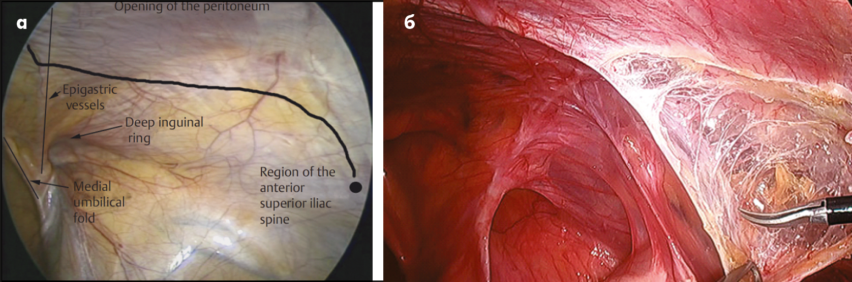 Рис. 25. Півмісяцевий розріз очеревини з опуклістю догори з правого боку при виконанні операції ТАРР (робот-асистованої – ​rТАРР) із приводу правобічної косої пахвинної грижі (а, б) [19]