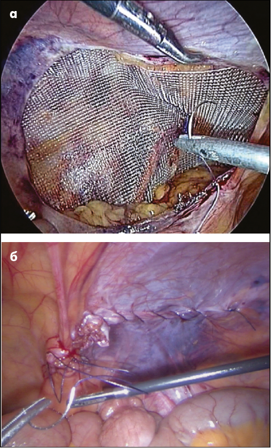 Рис. 27. Закриття очеревини над сітчастим імплантатом при виконанні операції ТАРР (а, б) [23]