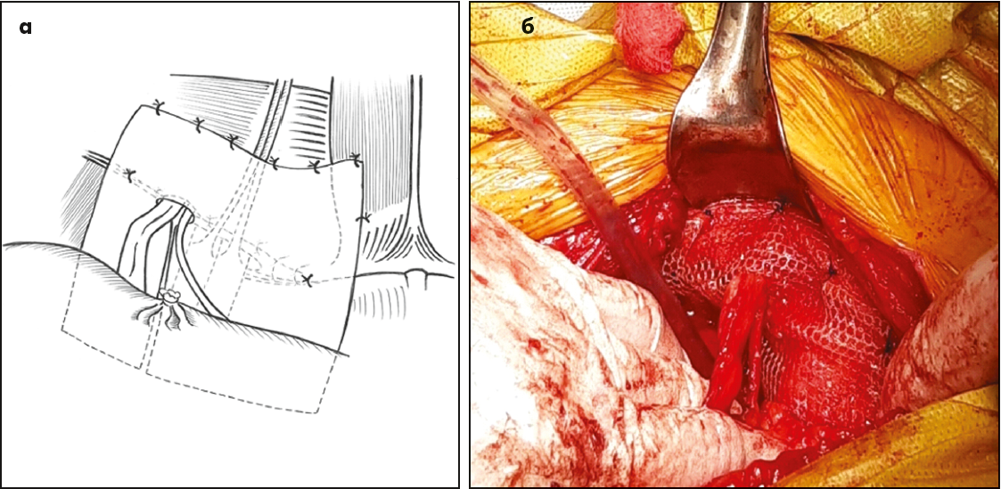 Рис. 28. Схематичний (а) та інтраопераційний (б) вигляд встановлення і фіксації сітчастого імплантату в лівому передочеревинному (ретроінгвінальному) просторі з отвором для сім’яного канатика при відкритій лівобічній передочеревинній пахвинній герніопластиці [6]