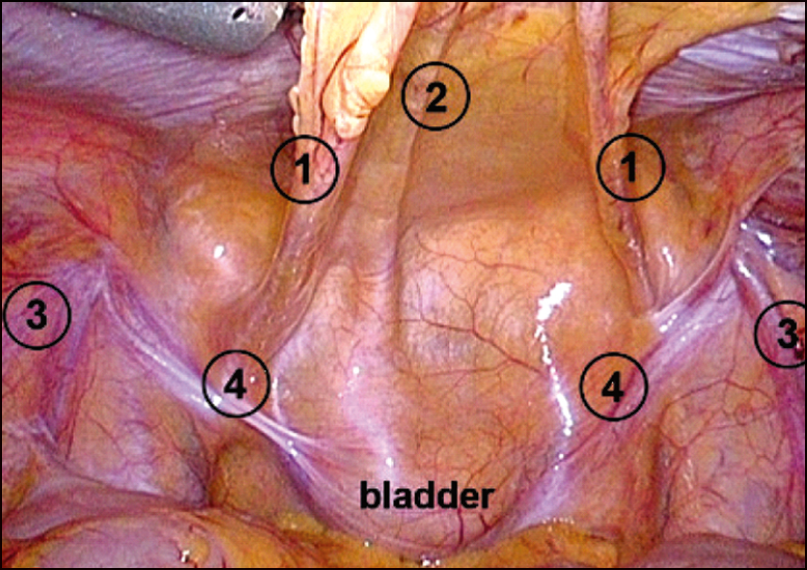 Рис. 3. Лапароскопічна анатомія та орієнтири на задній поверхні передньої черевної стінки [5, 6]:  1 – ​медіальна пупкова зв’язка (містить облітеровану пупкову артерію); 2 – ​серединна пупкова зв’язка (містить облітеровану сечову протоку); 3 – ​яєчкові судини; 4 – ​сім’явиносна протока