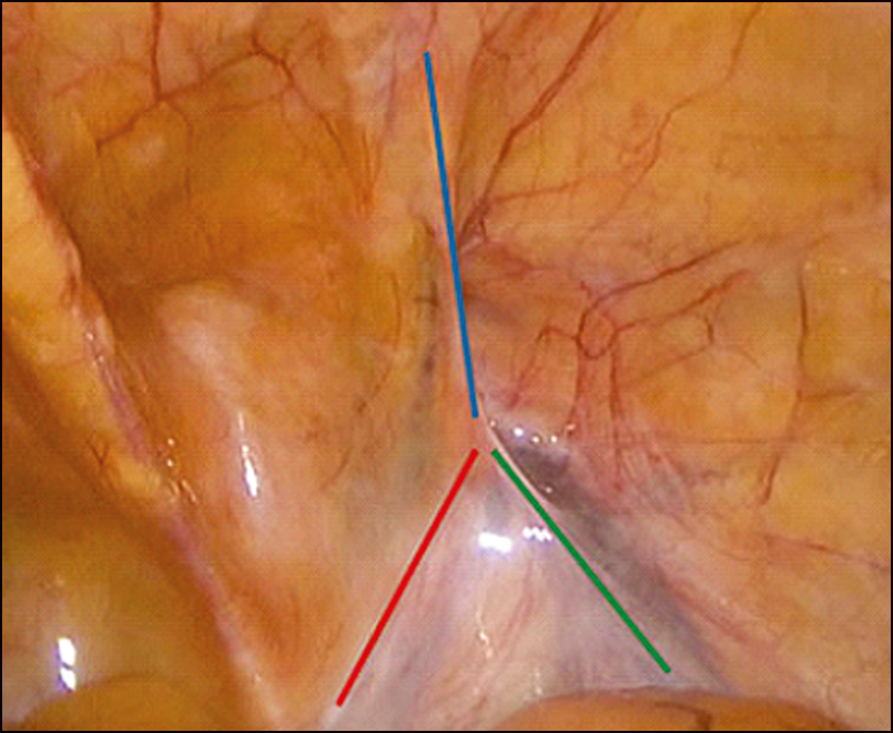 Рис. 5. Анатомічні орієнтири на задній поверхні передньої черевної стінки  при лапароскопії з правого боку: нижні надчеревні судини (синя лінія), сім’явиносна протока (червона лінія), яєчкові судини (зелена лінія) [17]