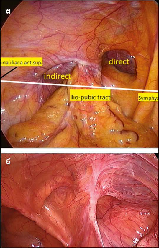 Рис. 8. Анатомічні орієнтири та вигляд «панталонних» пахвинних гриж (наявність одночасно прямої та косої пахвинних гриж) із боку черевної порожнини при лапароскопії (а, б) [19] 
