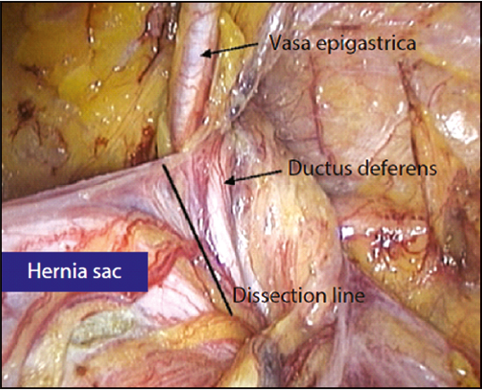 Рис. 9. Вигляд грижового мішка при лапароскопічній дисекції [19]