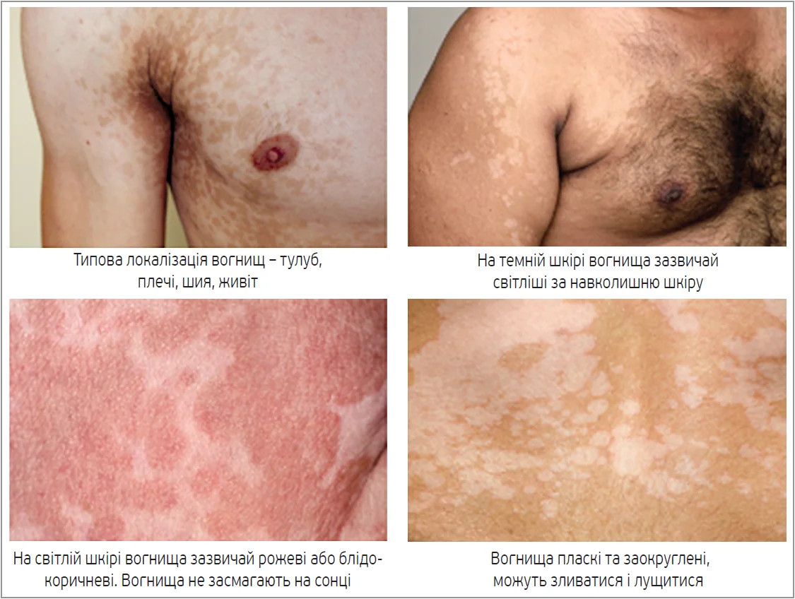 Рис. 1. Типовий вигляд pityriasis versicolor