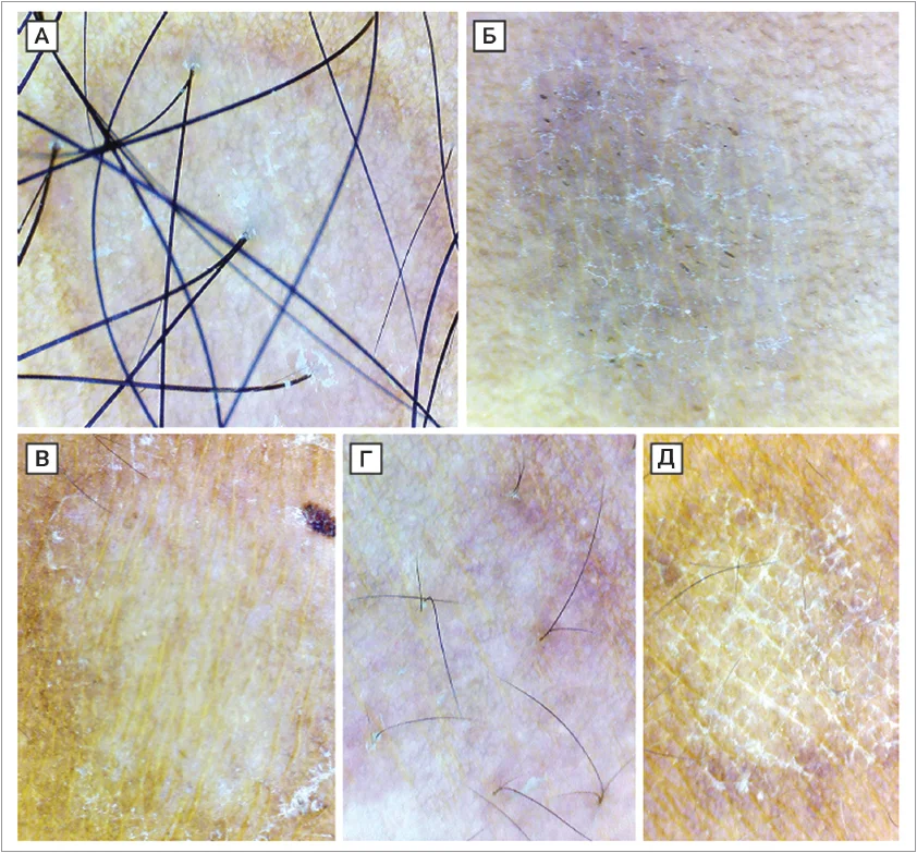 Рис. 4. Дерматоскопічні (збільшення ×10) патерни лущення за pityriasis versicolor. (A) Лущення в гіпопігментованому вогнищі. (Б) Дифузне лущення в гіперпігментованому вогнищі з одночасною наявністю лущення в борознах. (В) Периферійне лущення. (Г) Перифолікулярне лущення.  (Д) Лущення в борознах