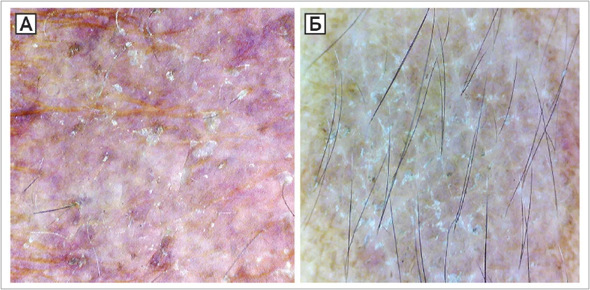 Рис. 5. Дерматоскопія (збільшення ×10): лущення за (A) хронічної ниркової недостатності  та (Б) системного червоного вовчака на тлі прийому кортикостероїдів