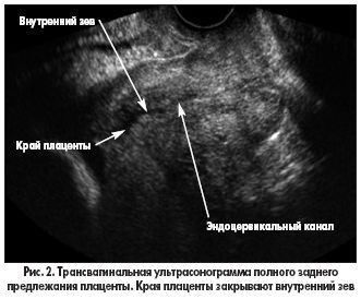 Зев закрыт при беременности. Расположение плаценты на УЗИ. Предлежание плаценты на УЗИ.