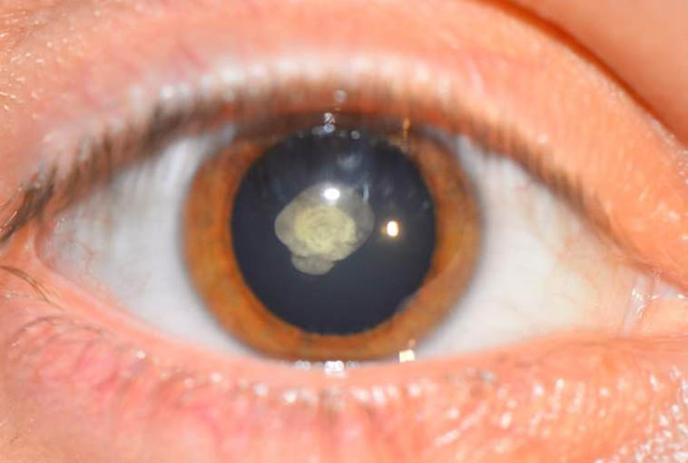 Офтальмологический раствор латанопростен-бунод 0,024%: новый вариант лечения открытоугольной глаукомы и глазной гипертензии