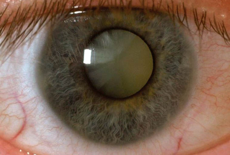 Кортикальная катаракта и аномалия рефракции