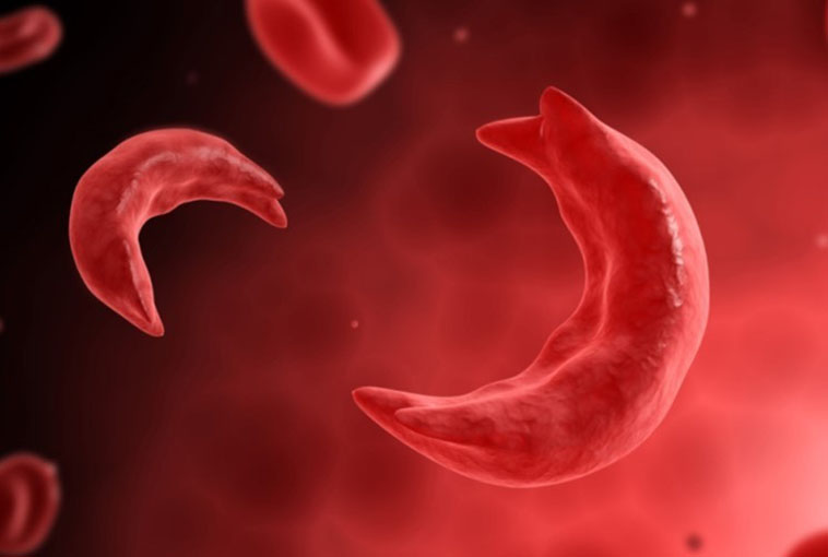 FDA одобрило препарат для лечения серповидно-клеточной анемии