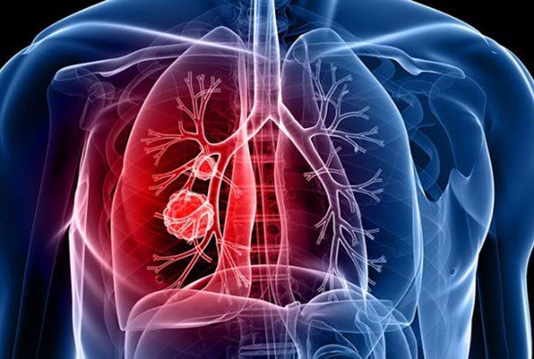 FDA затверджено першу ад’ювантну терапію для найпоширенішого типу раку легень