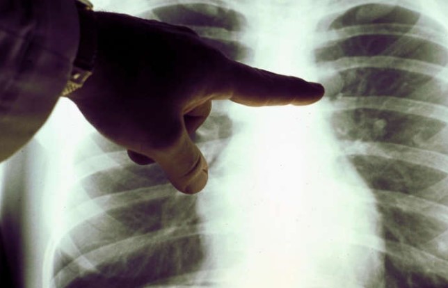 Більшість випадків раку легень у некурців піддаються лікуванню таргетними препаратами, що спрямовані на специфічні мутації-драйвери