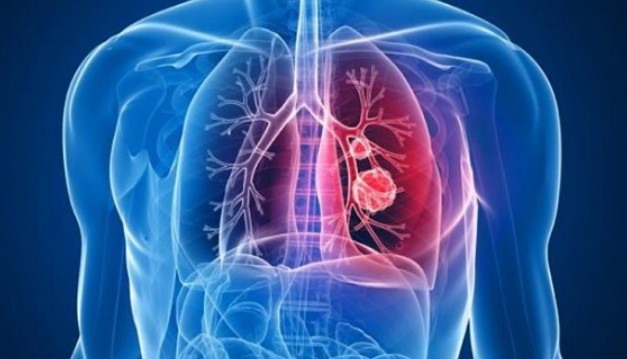 Чи може ацетилсаліцилова кислота подовжити виживання у пацієнтів із неоперабельним недрібноклітинним раком легень?