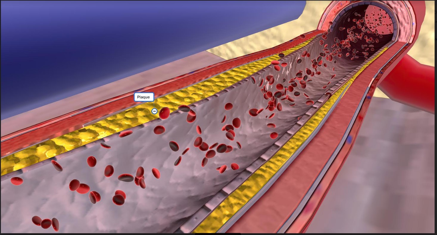 Новий шлях боротьби з основною причиною серцево-судинних захворювань – атеросклерозом