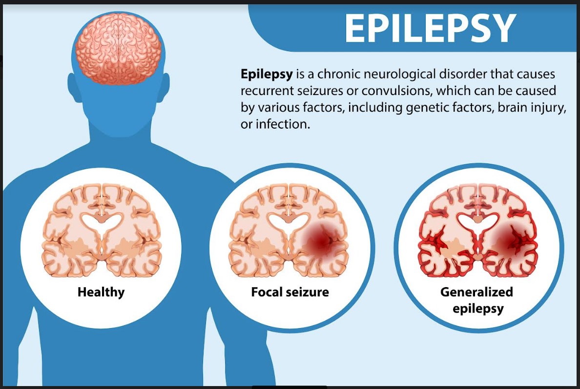 Лікарі стверджують, що кетогенна дієта стає рятівним засобом лікування для 4-річної пацієнтки з епілепсією