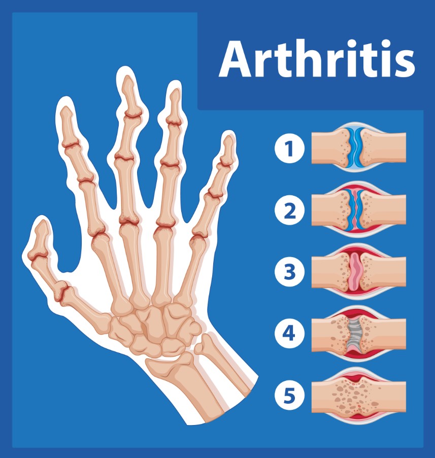 Ревматоїдний артрит: континуум захворювання, стратегії прогнозування, раннього втручання та профілактики