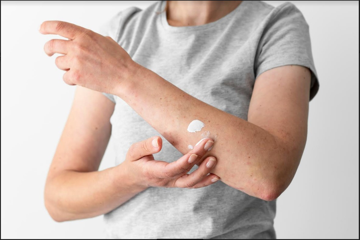 FDA схвалює новий препарат Zoryve для лікування атопічного дерматиту