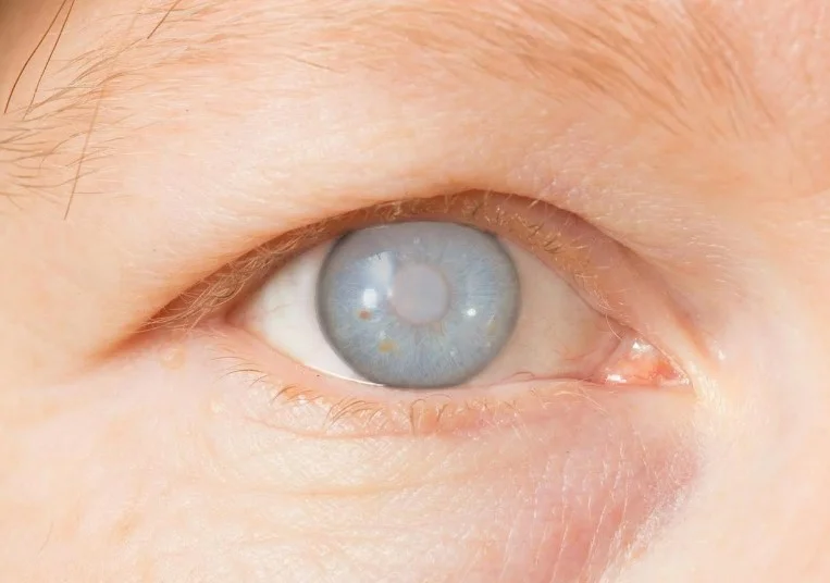 Офтальмохірурги провели першу у світі роботизовану операцію лікування катаракти