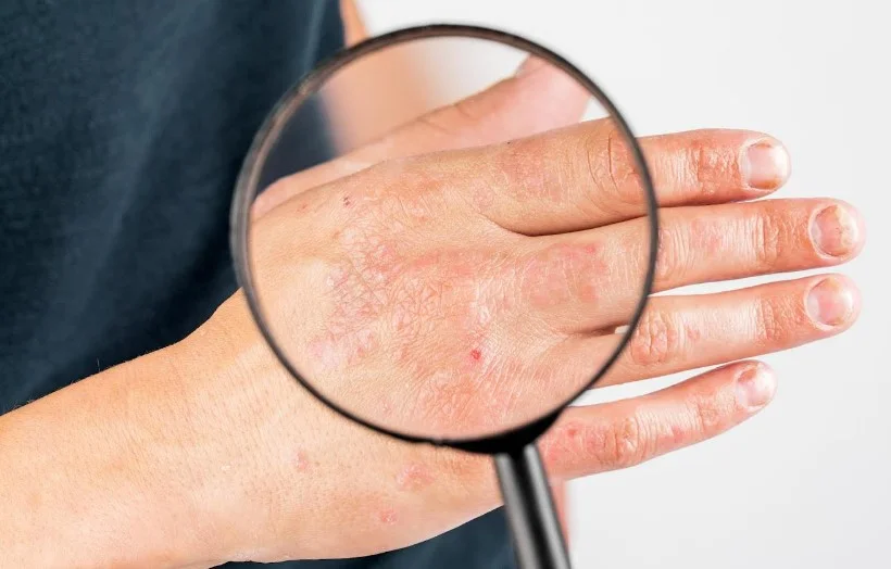 Рокатинлімаб - фармацевтичний прорив у лікуванні середньоважкого атопічного дерматиту