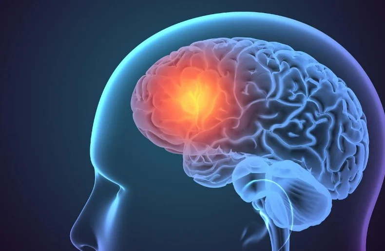 Гострий ішемічний інсульт: принципові зміни у рекомендаціях 2026 року