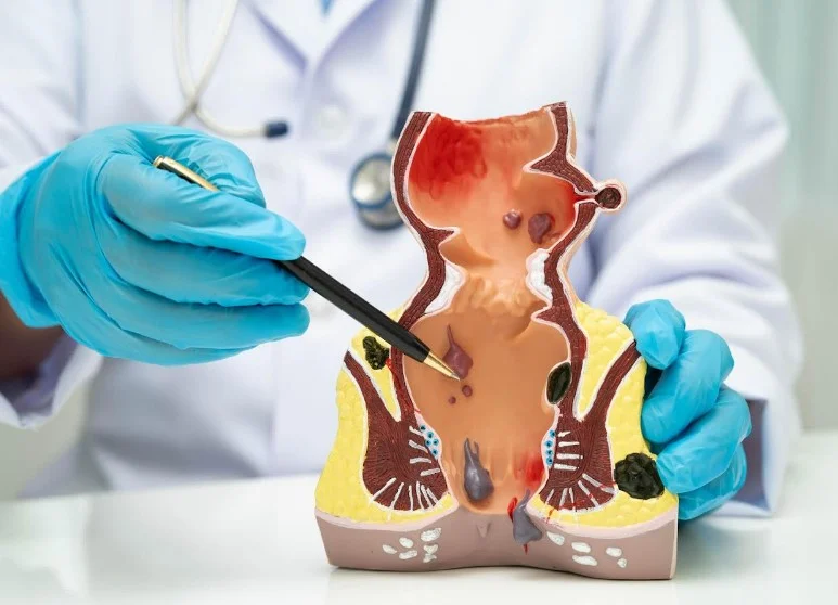 Наказ МОЗ № 304: уніфіковані стандарти діагностики та лікування анальної карциноми