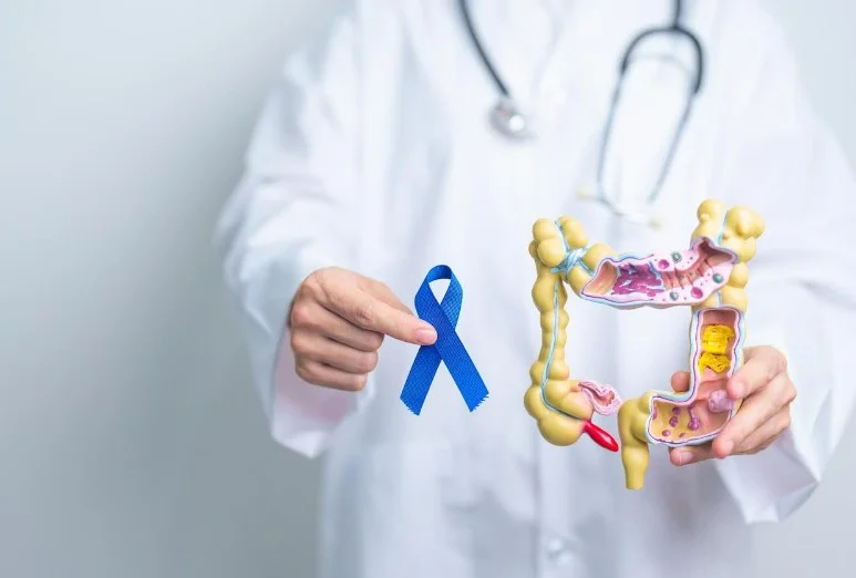 Нові рекомендації ESMO за метастатичного колоректального раку: ключові зміни оновлень 2026 року